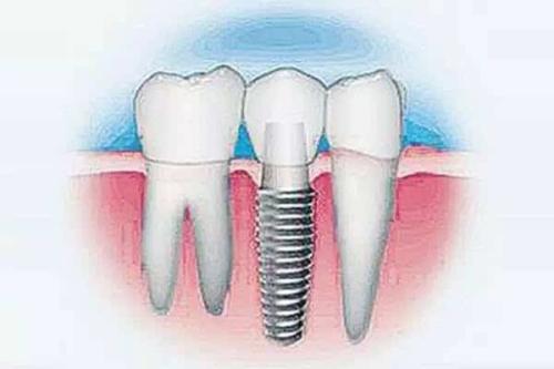 种植牙的最新政策与价格概述
